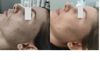 Авторский пилинг Анти-акне